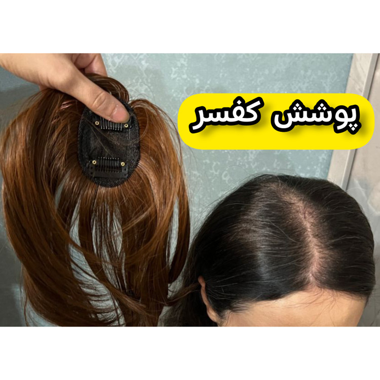 پروتز موی جلوی سری فرق پوستی