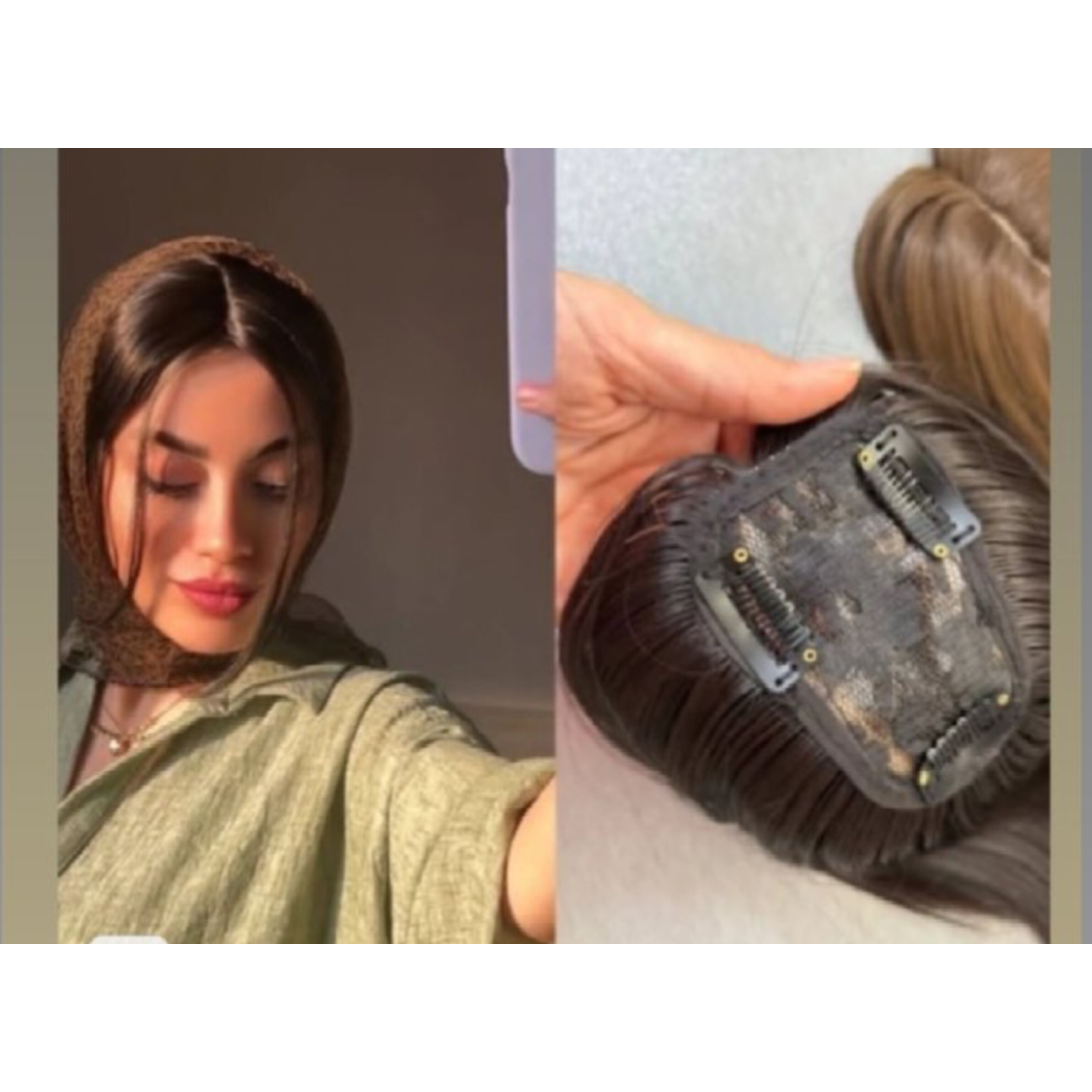 پروتز موی جلوی سری فرق پوستی